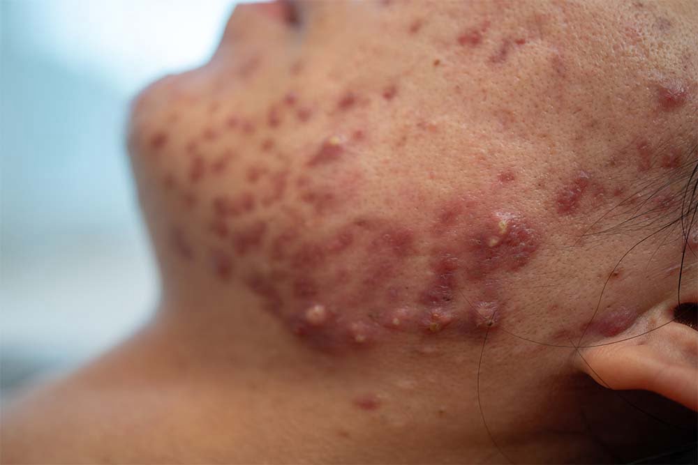 θεραπεία για την ακμή